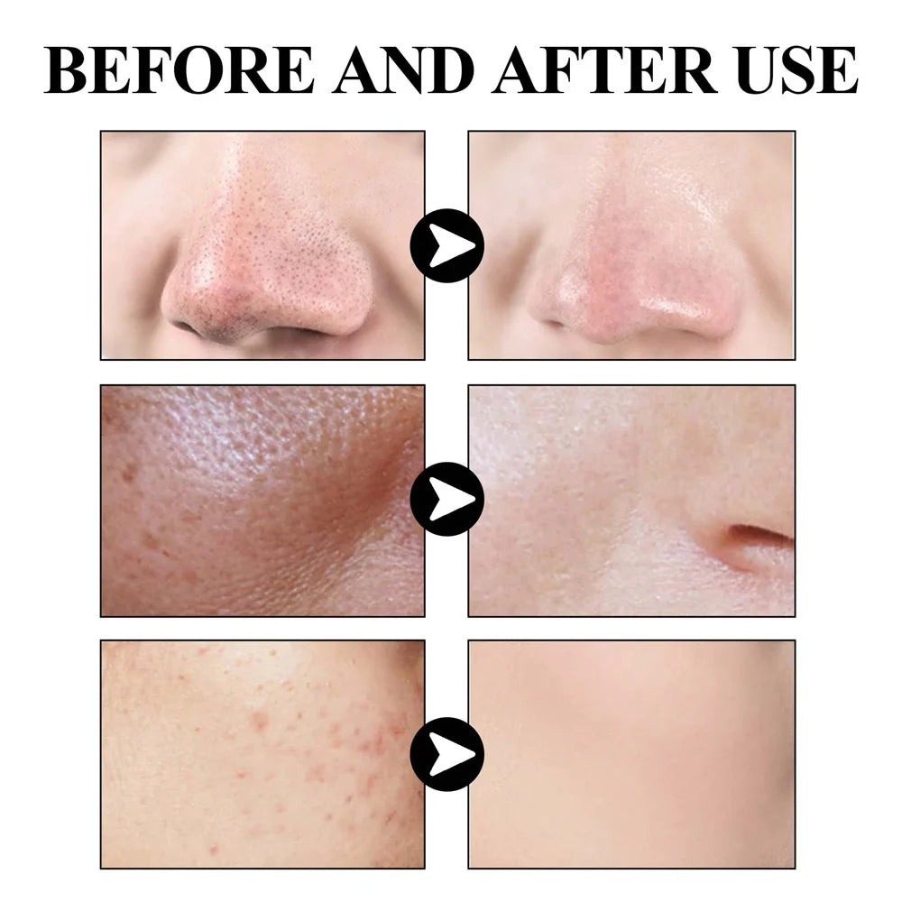 West & Month Blackhead Mud Mask Oil Control Treatment